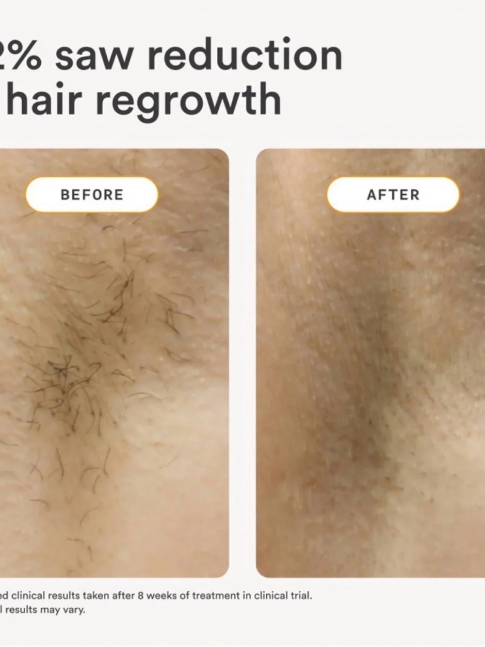 NEW SEALED Nood The Flasher 2.0 White IPL Hair Removal Device - Picture 3 of 5